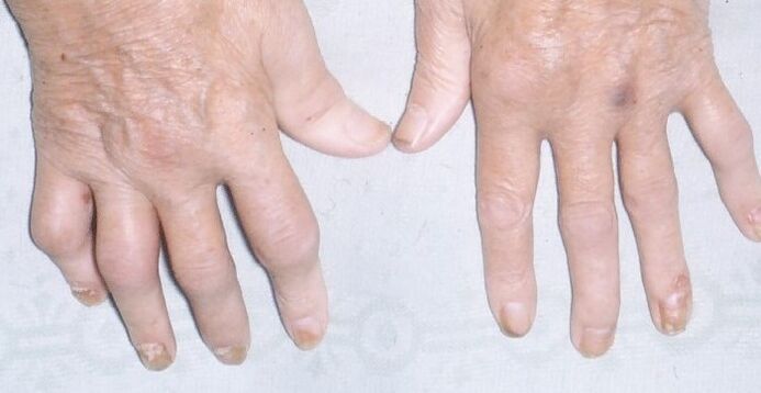 artropatická psoriáza na rukou