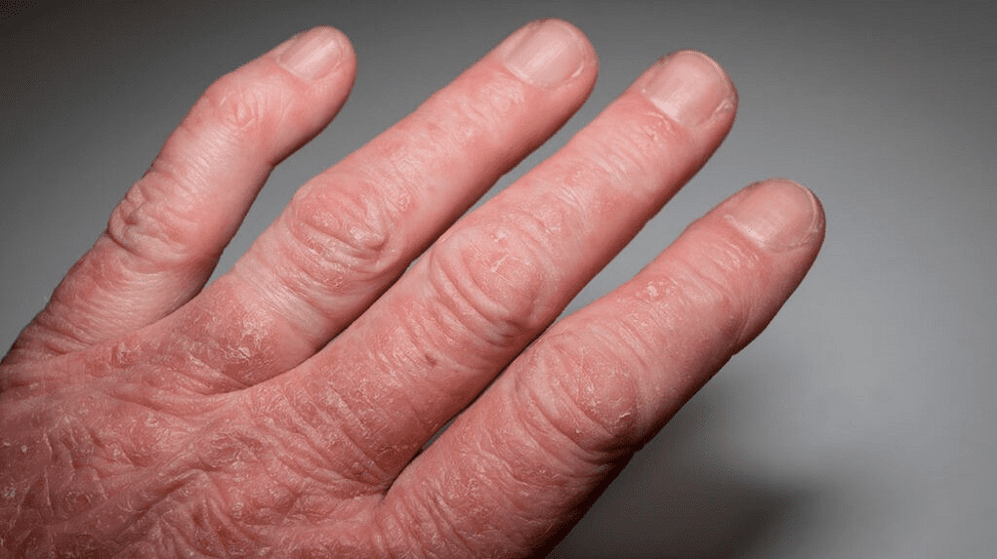 psoriatická artritida na rukou