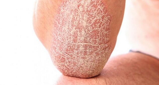 psoriasis vulgaris na kůži