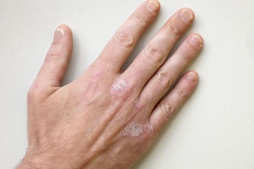 Povinným příznakem psoriázy jsou plaky se šupinami na kůži