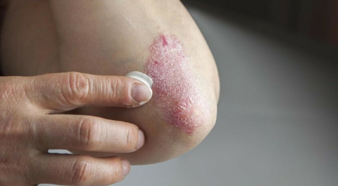 Psoriáza postihující kůži, jejíž léčba zahrnuje použití mastí