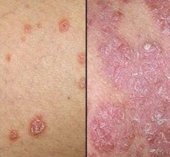 Psoriatické plaky
