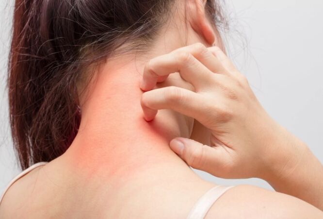 Svědění je jednou z příčin psoriázy