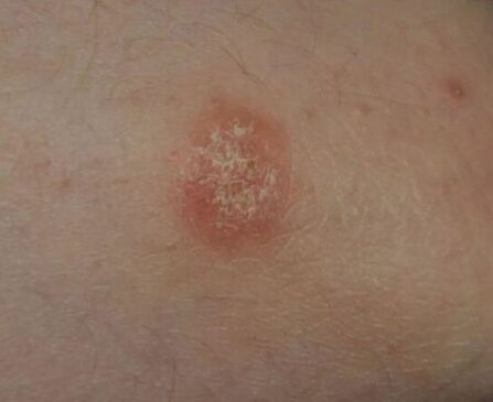 Psoriáza Spot