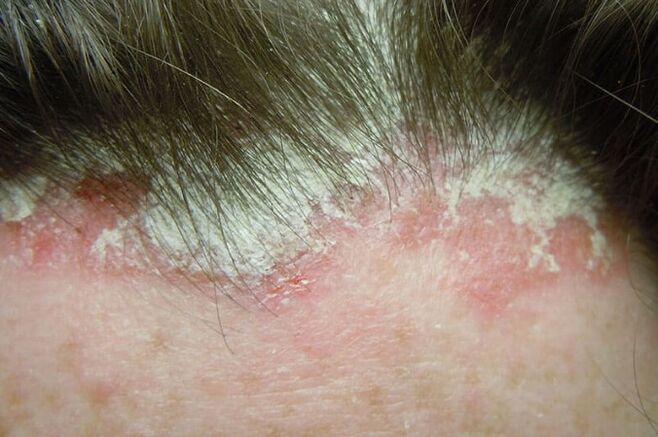 Psoriáza zachycuje celou chlupatou část hlavy