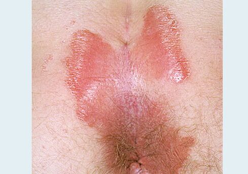 Close -Dispinning Psoriasis