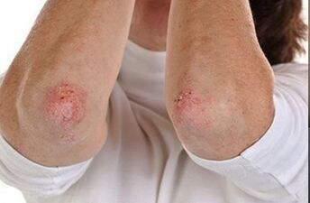 Psoriáza na loktech