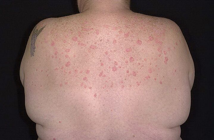 Psoriáza na ramenou
