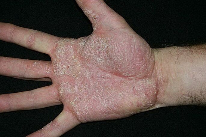 psoriáza dlaní a chodidel