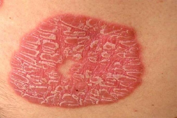 pustulární psoriáza