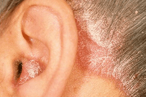 příčiny psoriázy